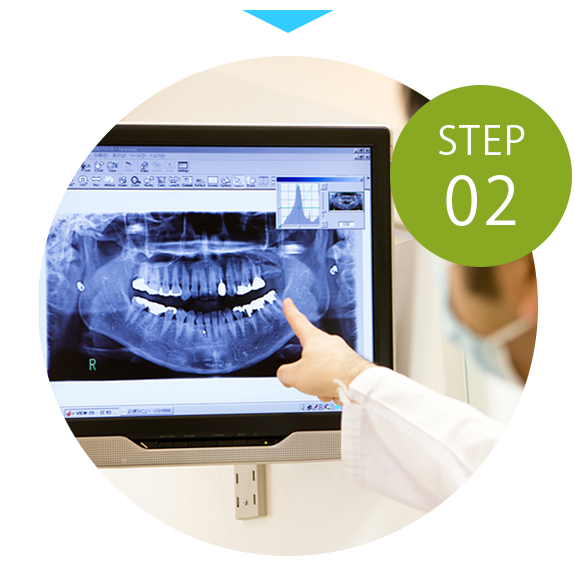 STEP02 精密検査・インビザライン型取り